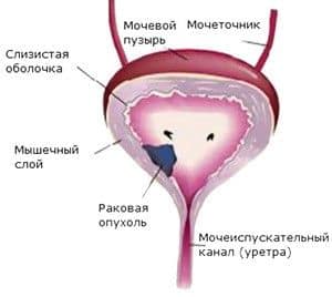 Симптомы болезни мочевого пузыря опухоль