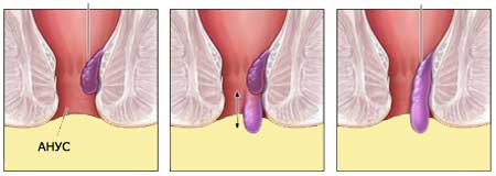 При выпадении внутреннего геморроидального узла, сфинктер может его пережать.