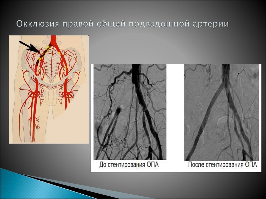 Окклюзия подвздошной артерии до и после стентирования