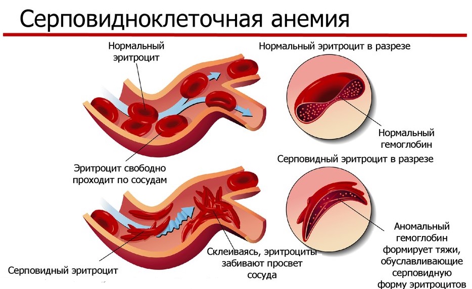 Форма эритроцитов при серповидноклеточной анемии