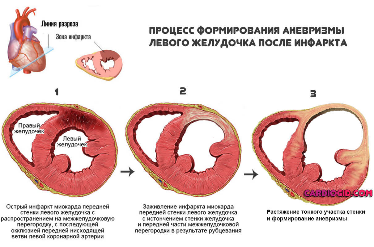 Процесс формирования аневризмы левого желудочка
