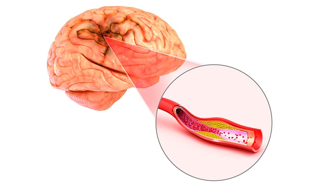 Атеросклеротическая бляшка в артериях мозга