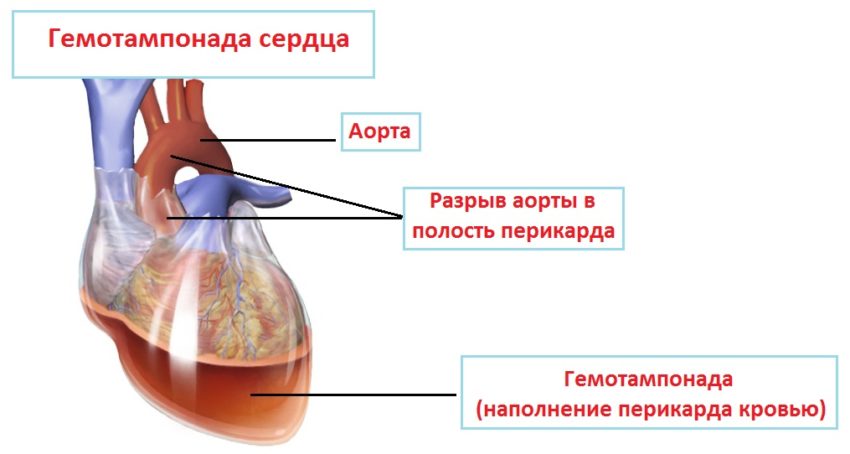 Гемотампонада сердца