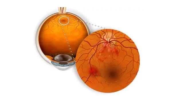 Сетчатка глаза – ретинопатия