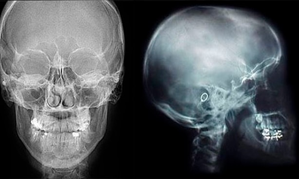 Краниография - рентген головы