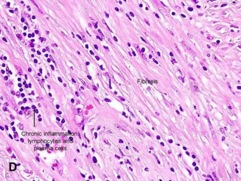 Фото гистологического препарата почечной паренхимы с ретроперитонеальным фиброзом (болезнь Ормонда)