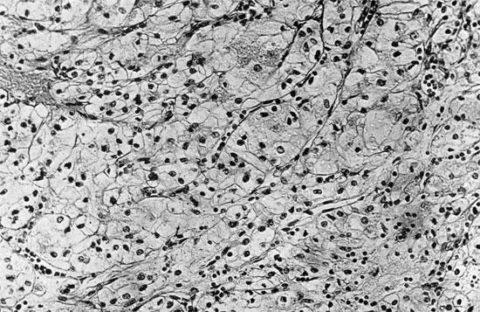 Фото клеточной структуры аденомы почки