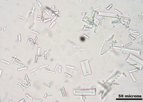 Фото песка (солевых кристаллов) в моче под микроскопом (50 мкм)