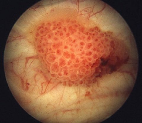 Фото рака мочевого пузыря сделанное методом цитоскопии