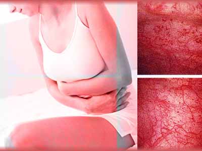 Гангренозный тип воспаления характеризуется отмиранием тканей.