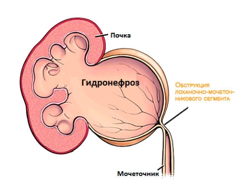 Гидронефроз почки – сложное заболевание, характеризующееся нарушением тока урины и скоплением жидкости в почках.