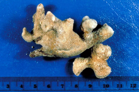 Коралловидные конкременты считаются самыми опасными, они могут застилать всю полость парного органа.