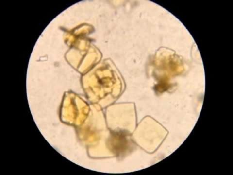 На фото моча под микроскопом при кристаллурии.