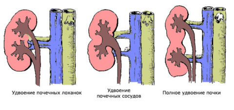 На фото различные типы анатомической структуры удвоения почек.