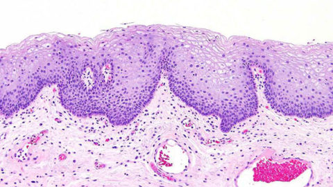 На фото цитологический препарат с метаплазией слизистого эпителиального слоя мочевого пузыря