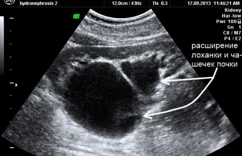 На фото УЗИ снимок воспаленной почки с признаками гидронефроза.