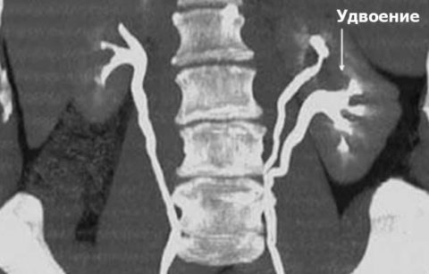 На рентгеноскопии с контрастированием левостороннее удвоение почки с отдельным чашечно-лоханным сегментом.