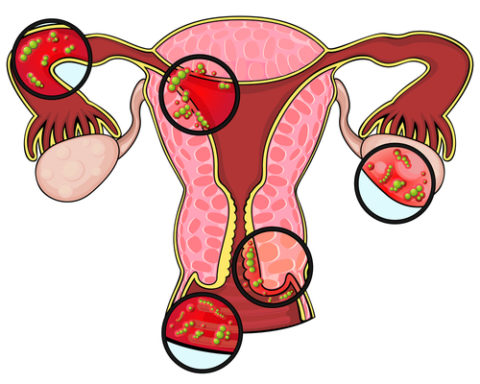 Одной из причин появления болевого синдрома во время мочеотделения является вагинит