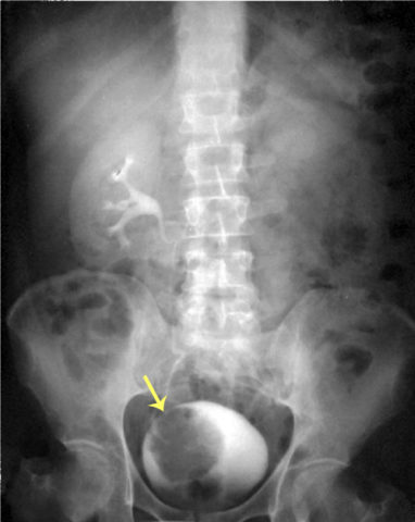 Опухоль мочевика на рентгеновском фото