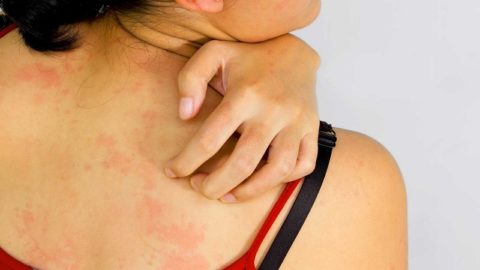 Редко после приема лекарства развивается аллергическая сыпь на коже