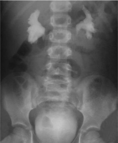 Рентген снимок почек при пиелоэктазии.