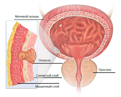 Схематическое изображение опухоли в мочевом пузыре у мужчины