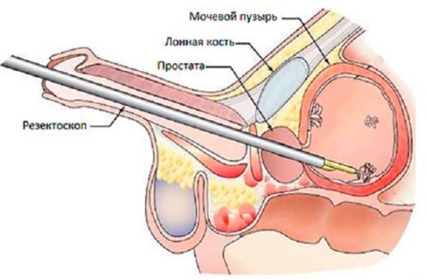 Трансуретральная резекция рака мочевого пузыря
