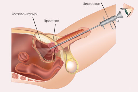 Цитоскопия мочевого пузыря у мужчин