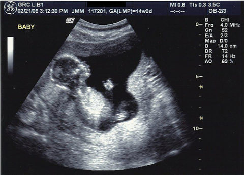 УЗИ позволяет на ранних сроках беременности выявить аномалии развития внутренних органов у плода.