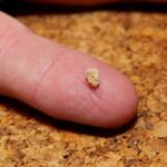 Выход песка и камней небольшого размера обычно не сопровождается негативной симптоматикой.